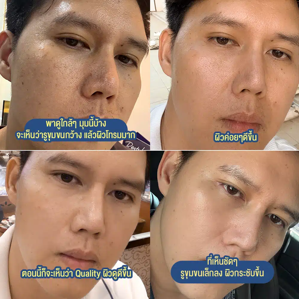 รีวิว Profhilo ที่ Wandee Clinic