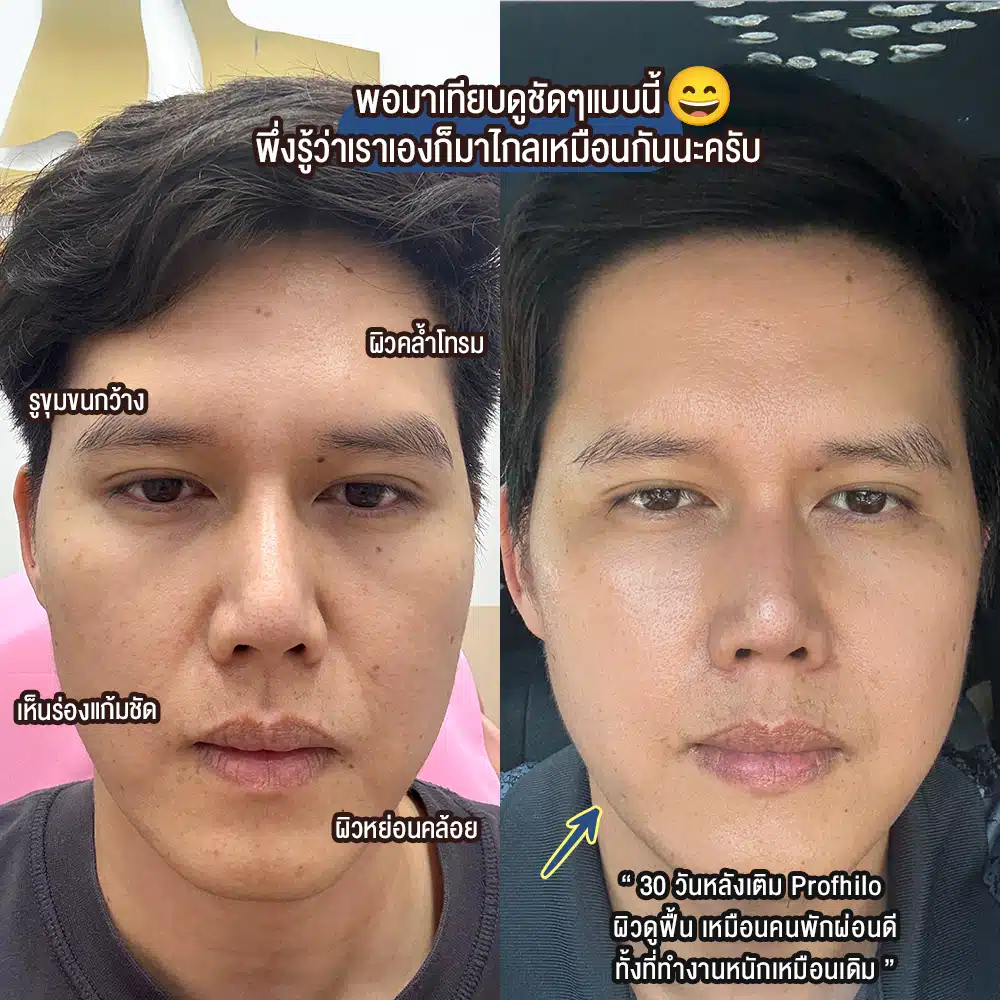 รีวิว Profhilo ที่ Wandee Clinic