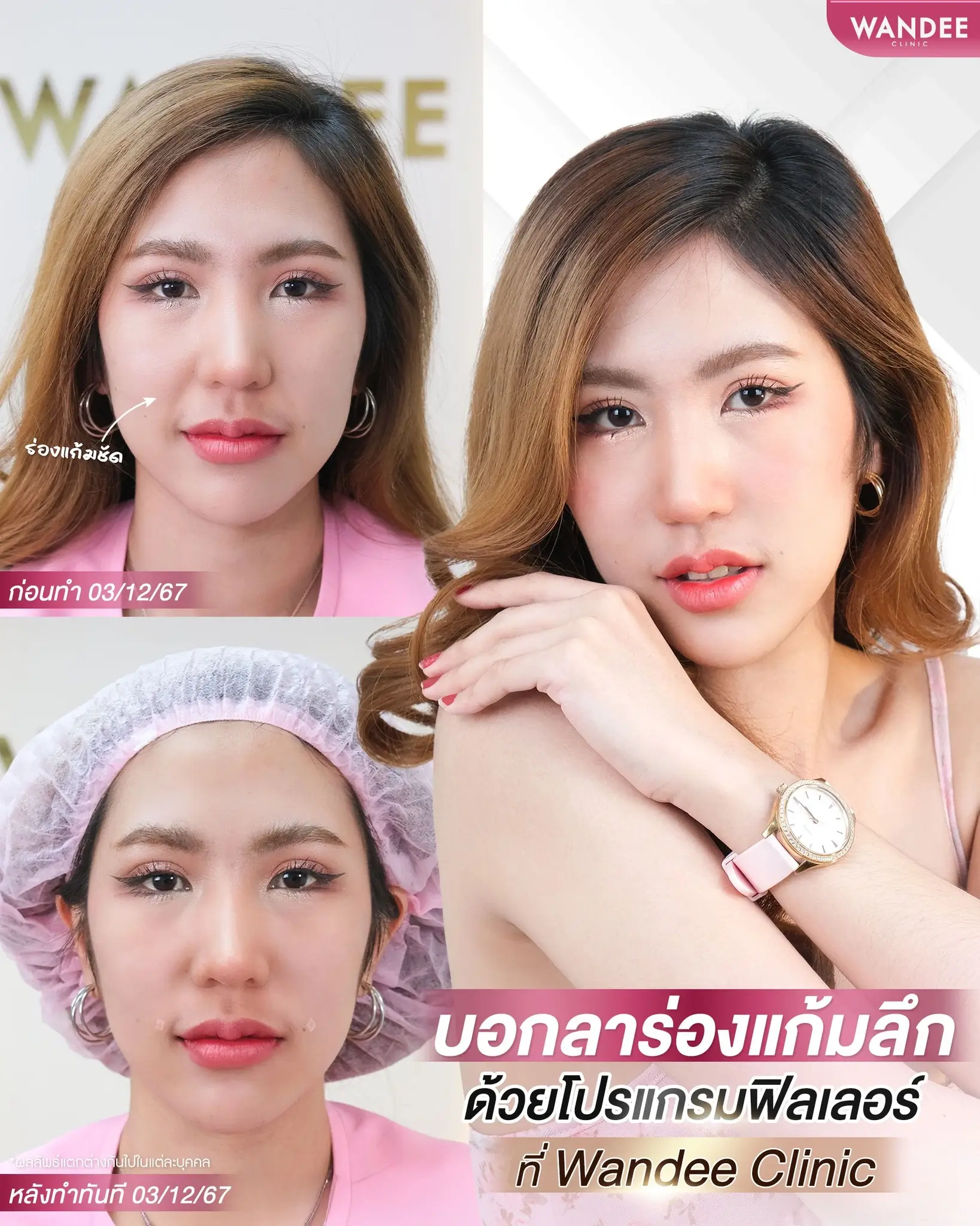 ร่องแก้มลึก โปรแกรม 𝗙𝗶𝗹𝗹𝗲𝗿 รีเซ็ตหน้าเด็ก