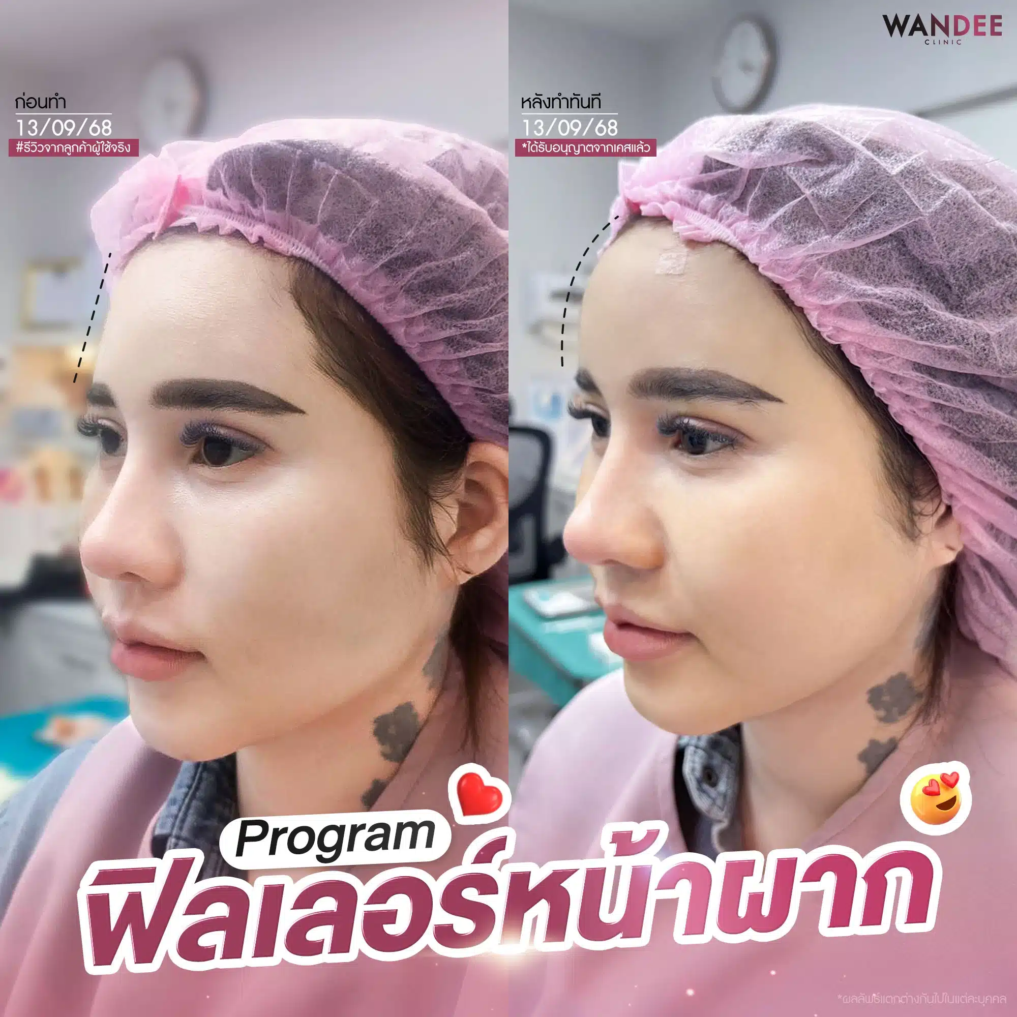 หน้าผากละมุนสวย