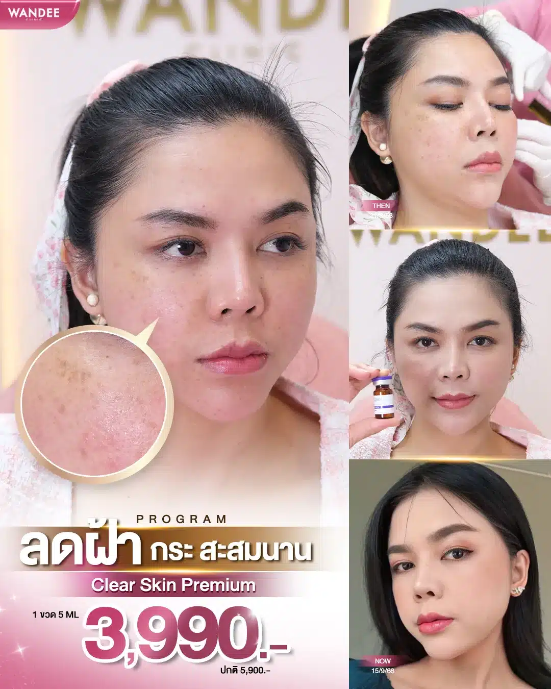 Reduce freckles that have accumulated over a long time