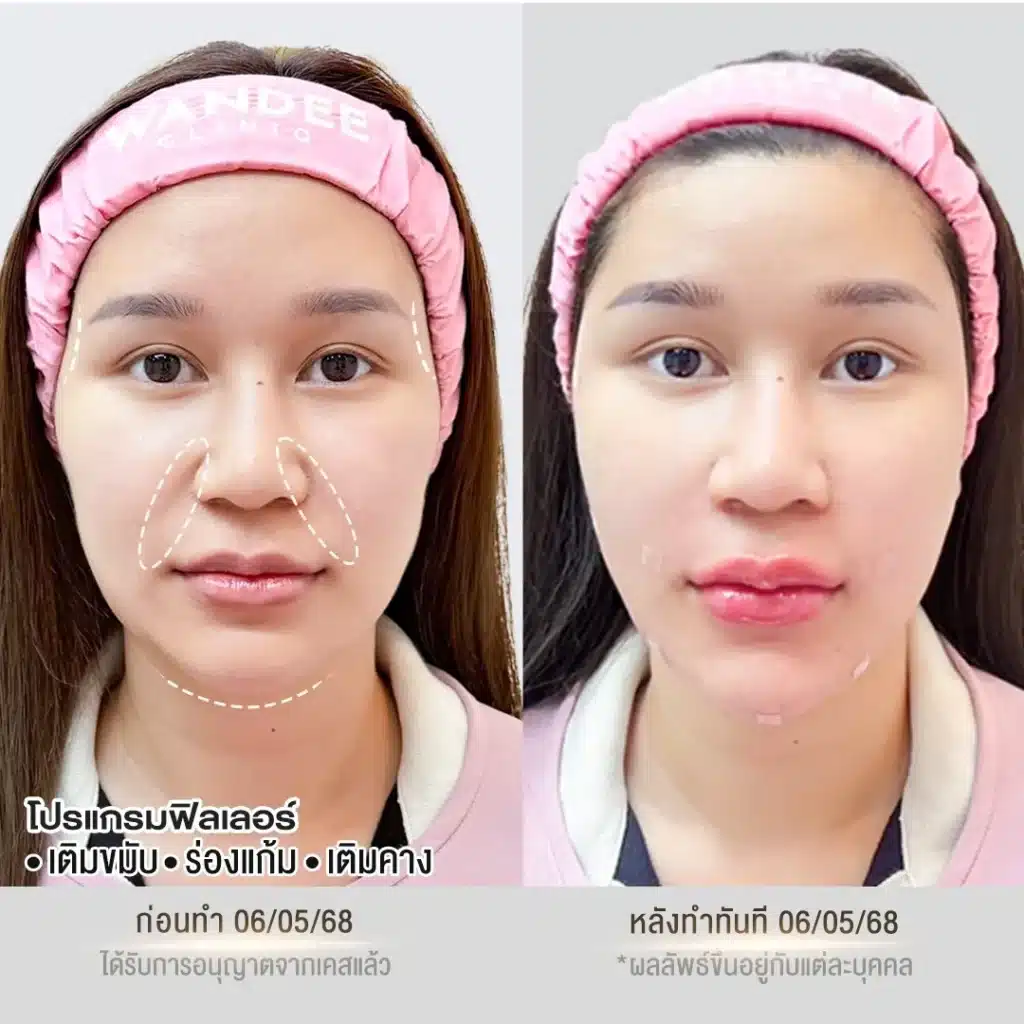 หน้าเด็กละมุนขึ้น