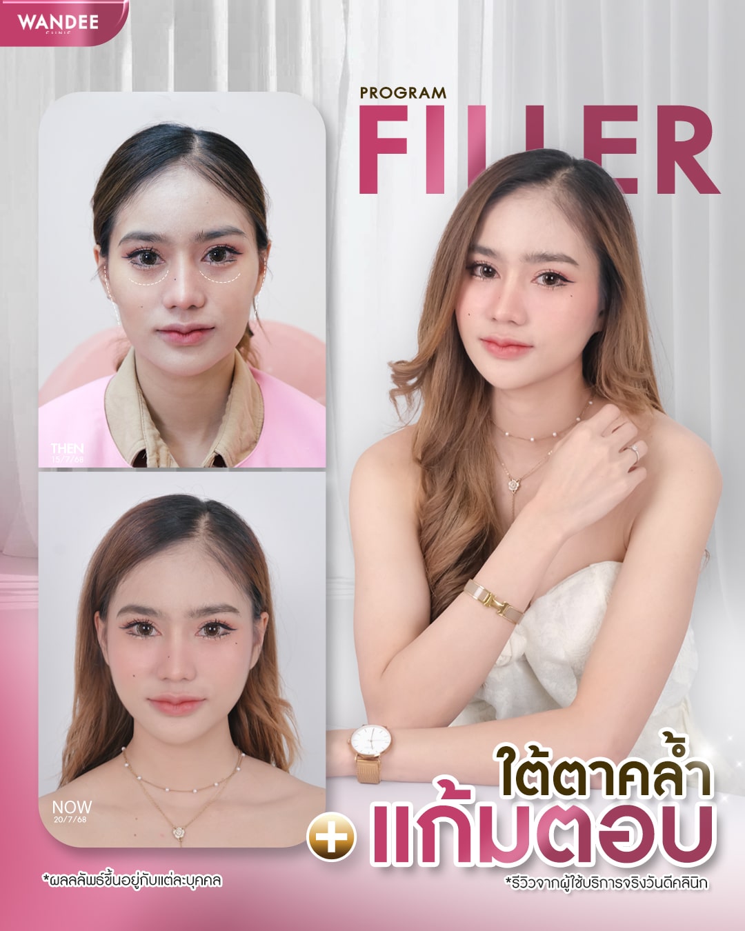 รีวิวฟิลเลอร์ใต้ตา