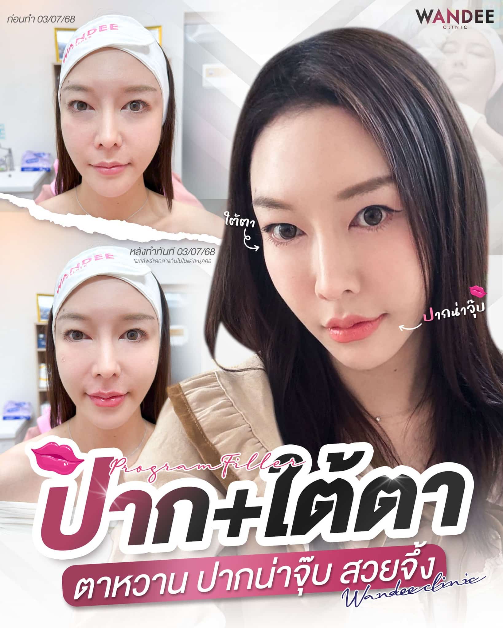 รีวิวฟิลเลอร์ ปาก+ใต้ตา