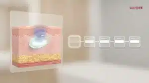 ฟิลเลอร์บวมกี่วันช้ำกี่วัน ไทม์ไลน์อาการปกติและสัญญาณอันตรายหลังฉีด